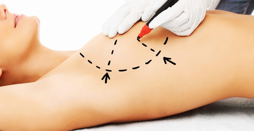 Bruststraffung und Bauchdeckenstraffung: Perfekte Kombination für Ihre Silhouette