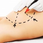 Bruststraffung und Bauchdeckenstraffung: Perfekte Kombination für Ihre Silhouette